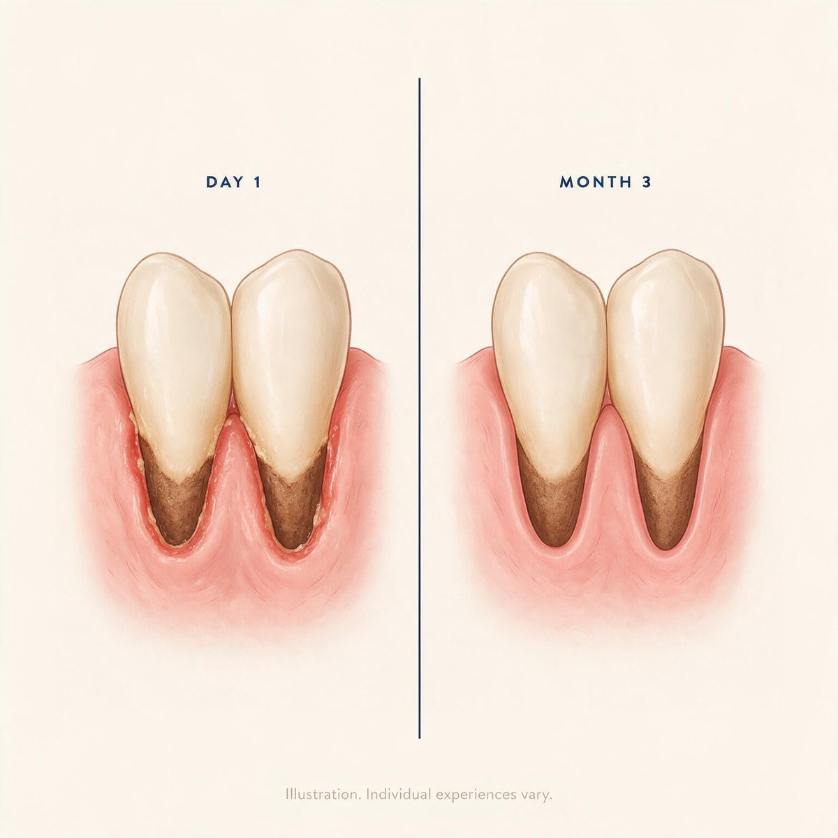 illustration comparing inflamed gums at day one with calmer gums at month three
