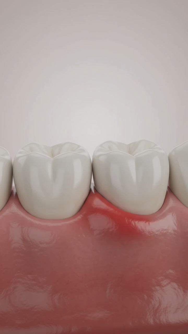 Illustration of the smilume brush head resting on an inflamed gum line with red light travelling through the filaments