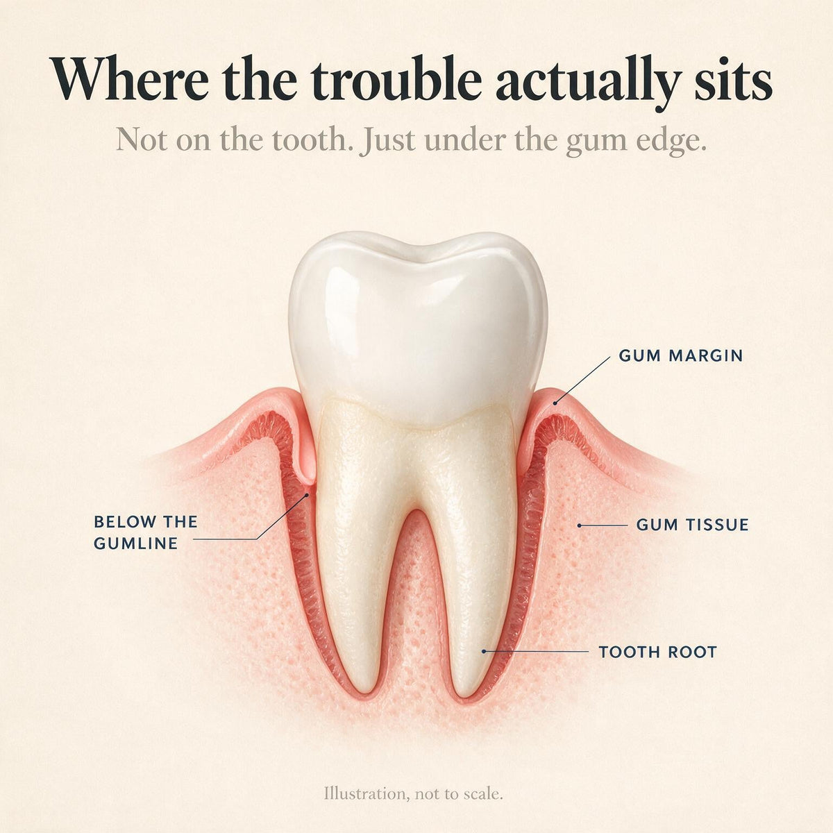 illustration of a tooth in cross section showing the space below the gumline